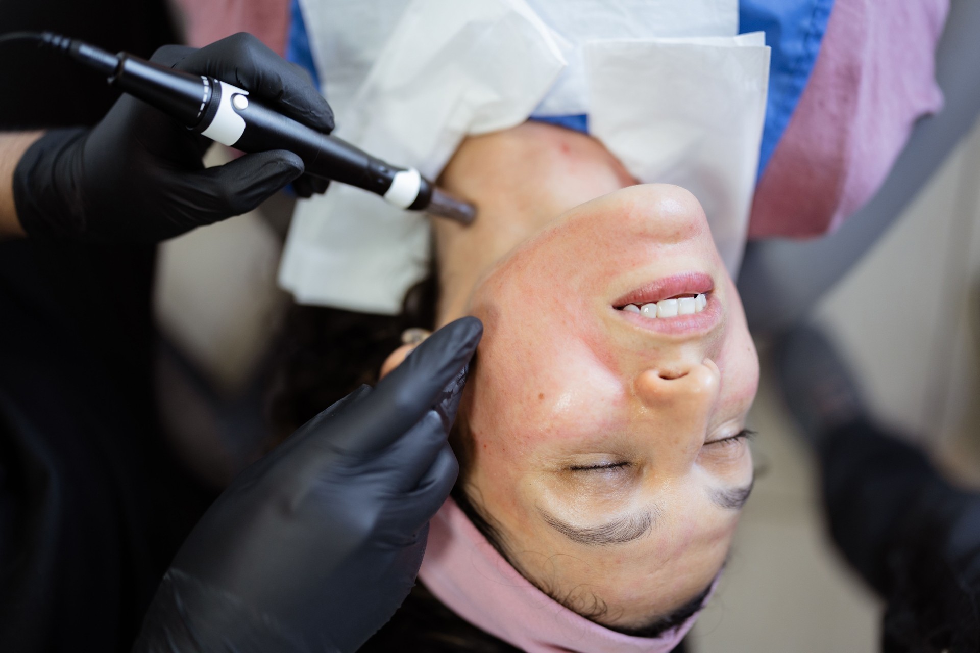 Beautician applying platelet-rich plasma therapy to face with dermapen